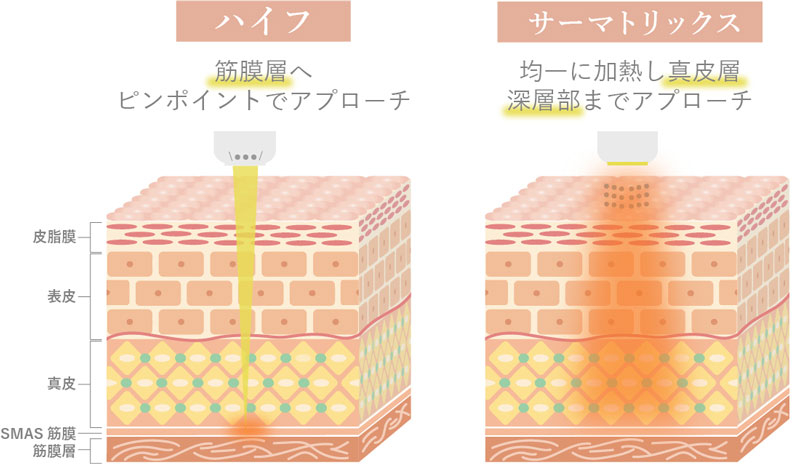 サーマトリックスとハイフの違いイラスト